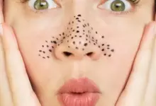 черни точки
