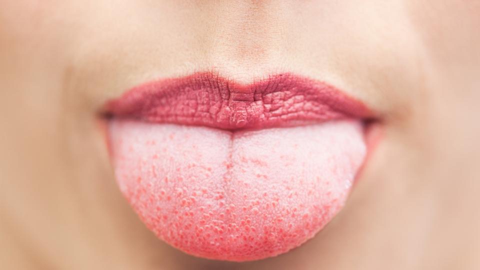 Имате обложен език – сигнал от тялото за лечение!