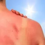 Слънчевата алергия е опасна за хора с болни бъбреци